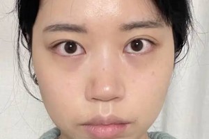 从南方到北京，26岁女士来做鼻整形手术，整完后朋友都说像某明星